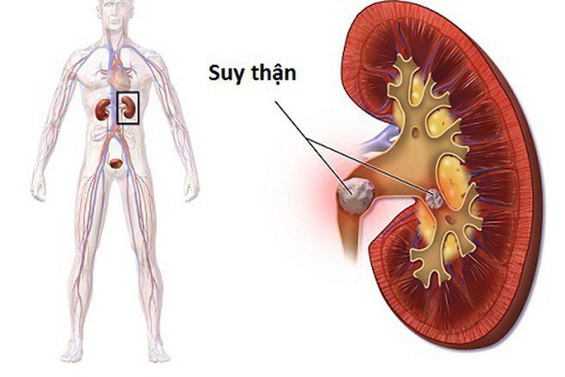 Triệu chứng bệnh thận bạn không nên bỏ qua!